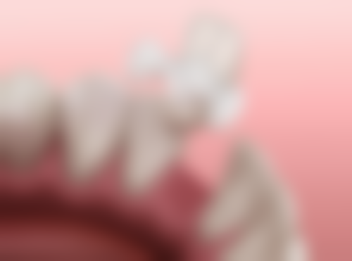 三、影响半口种植牙价格的主要因素