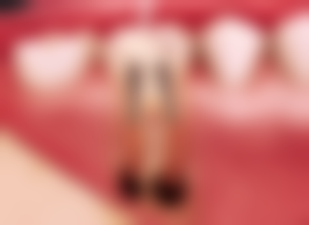 九、老年人适合做种植牙吗？