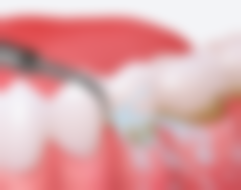 60岁老人半口种植牙术后1年分享：价格、体验与修复全过程